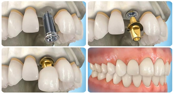 Cho ai thắc mắc giá cấy ghép implant bao nhiêu