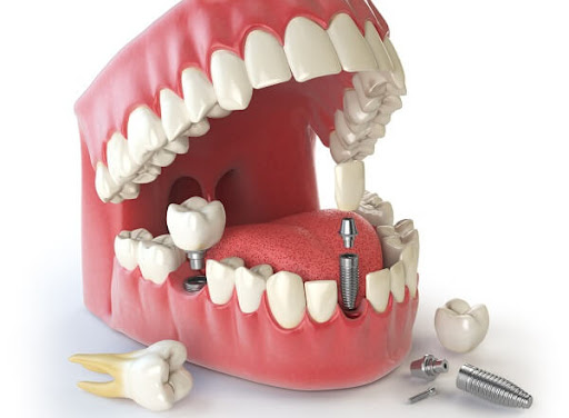 Cho ai thắc mắc giá cấy ghép implant bao nhiêu