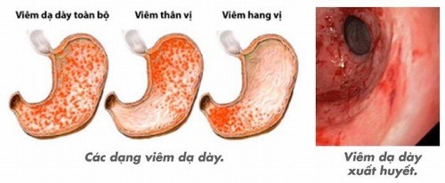 CHỚ chủ quan những nguyên nhân Viêm dạ dày thường gặp nhất