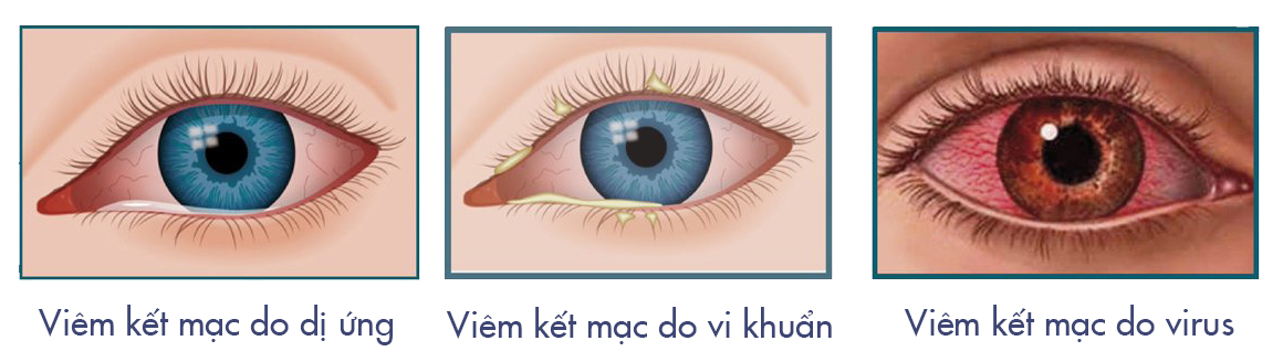 Chớ coi thường bệnh viêm kết mạc mắt