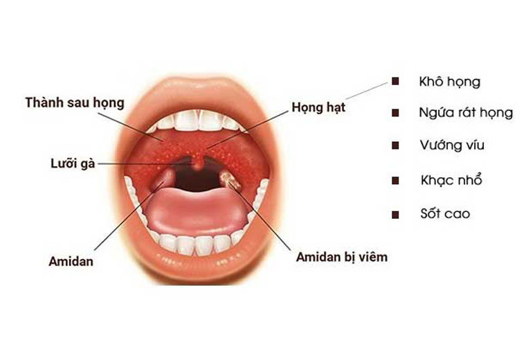 Chớ coi thường những biểu hiện viêm họng hạt