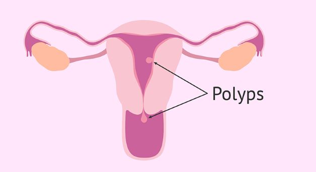 Chớ nên chủ quan với bệnh polyp tử cung ở phụ nữ