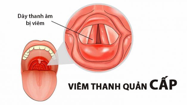 Chớ nên coi thường triệu chứng khàn tiếng kéo dài