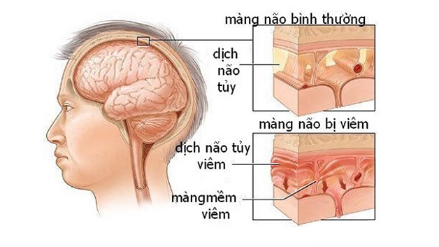 Chớ nên coi thường việc tiêm phòng vắc xin viêm màng não mô cầu