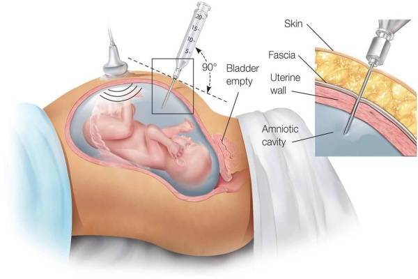 Chọc ối xét nghiệm có đau không?