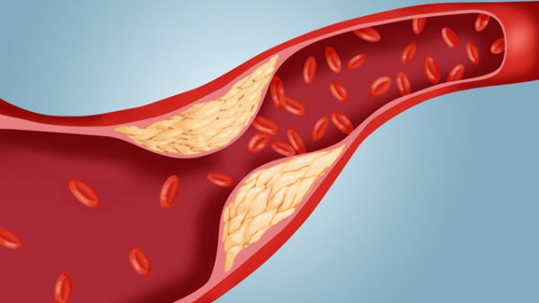 Cholesterol tăng cao có thể dẫn đến bệnh gì?