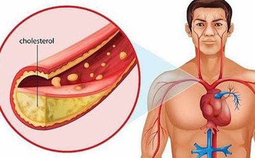 Cholesterol trong máu cao nên ăn gì?