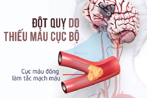 Chóng mặt do thiếu máu não nên ăn gì?