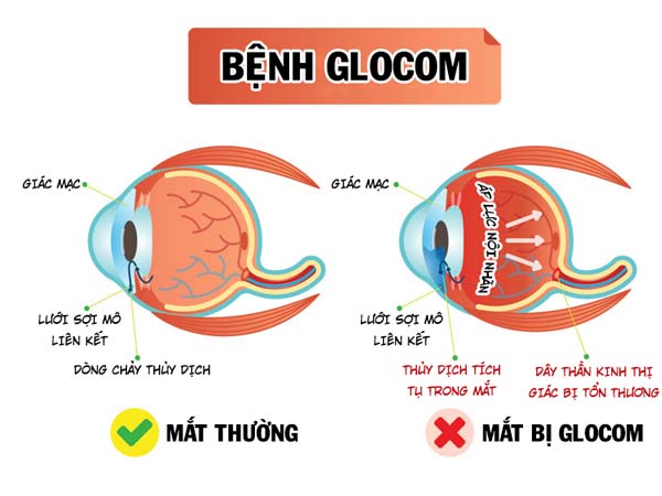 Chú ý đề phòng biến chứng sau mổ glocom