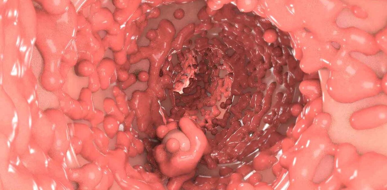 Chữa bệnh đa polyp đại tràng như thế nào?