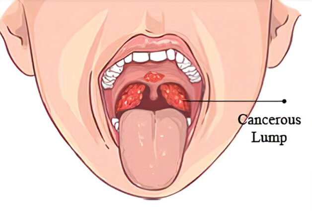 Chữa bệnh ung thư vòm họng ở đâu hiệu quả