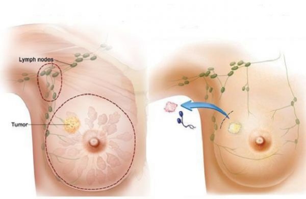 Chữa bệnh ung thư vú – Phương pháp, những điều cần biết