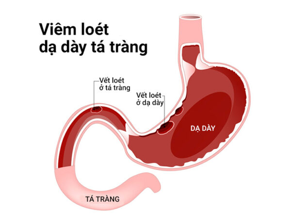 Chữa bệnh viêm loét dạ dày tá tràng