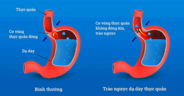 Chữa hen phế quản dịp Tết và những lưu ý quan trọng cần biết