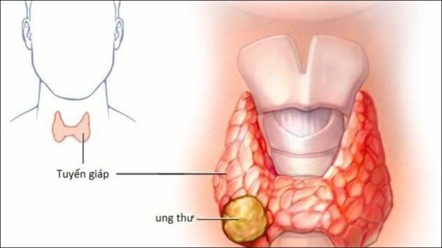 Chữa khỏi ung thư tuyến giáp với phác đồ trúng đích