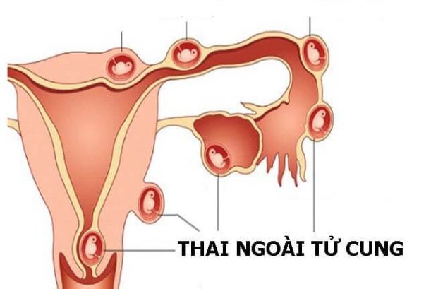 Chửa ngoài dạ con cắt 1 bên buồng trứng có thai được không?