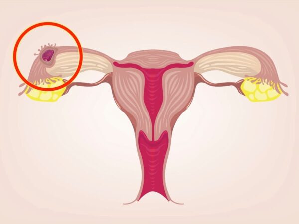 Chửa ngoài dạ con có giữ được không?