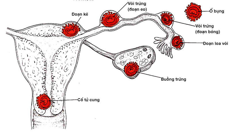 Chửa ngoài dạ con là như thế nào? nguyên nhân cụ thể