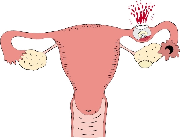 Chửa ngoài tử cung bị vỡ – Tai nạn sản khoa nguy hiểm chị em cần lưu ý