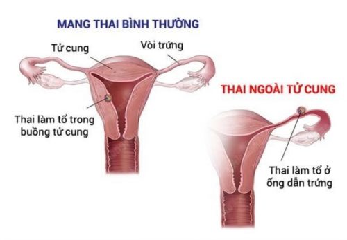 Chửa ngoài tử cung có nguy hiểm không và cách xử lý như thế nào?