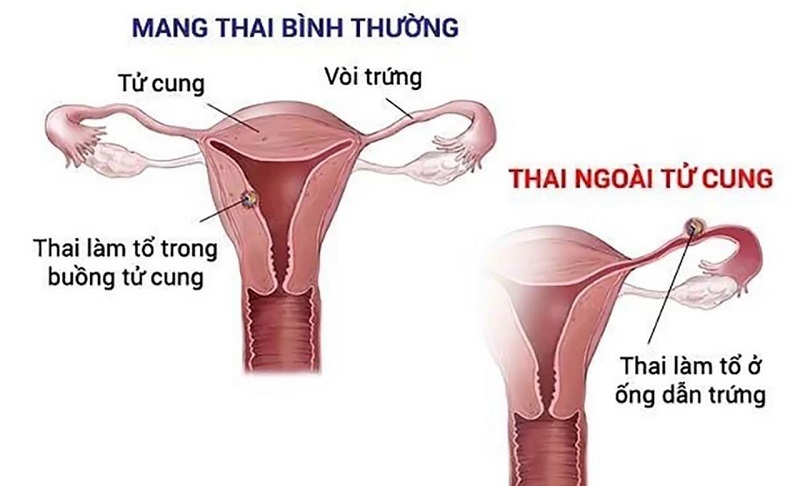 Chửa ngoài tử cung nguy hiểm thế nào và cách nhận biết sớm