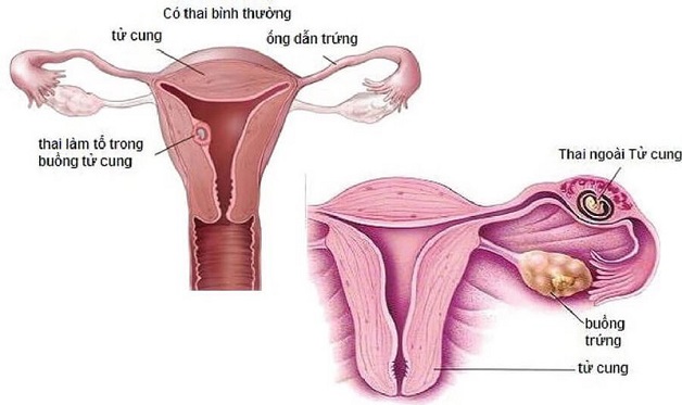 Chửa ngoài tử cung thử que có lên không?