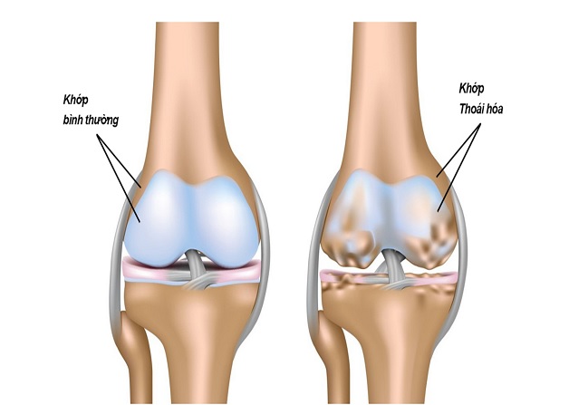 Chữa thoái hóa khớp gối đúng cách như thế nào?