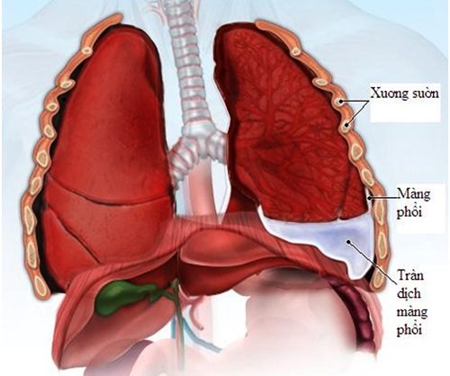 Chữa tràn dịch màng phổi càng được thực hiện sớm càng tốt