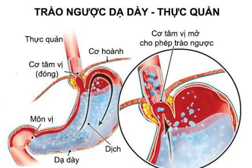 Chữa trào ngược dạ dày thực quản bằng Đông y