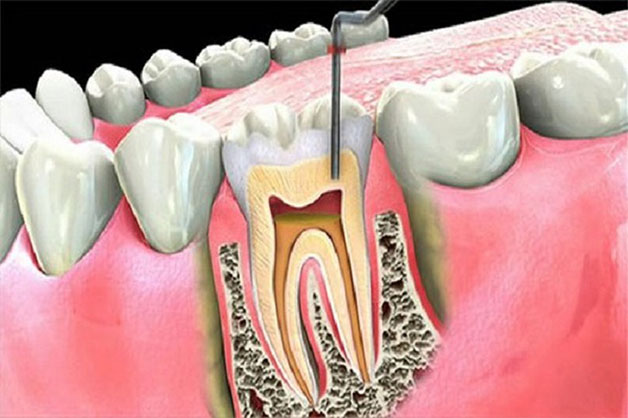 Chữa tủy răng có đau không và quy trình điều trị tủy răng