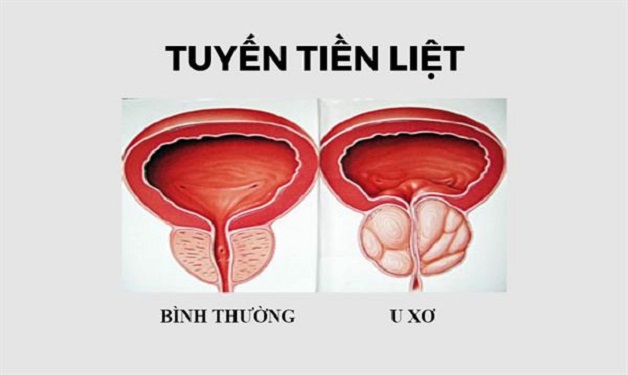 Chữa u xơ tuyến tiền liệt bằng phương pháp nào hiệu quả?