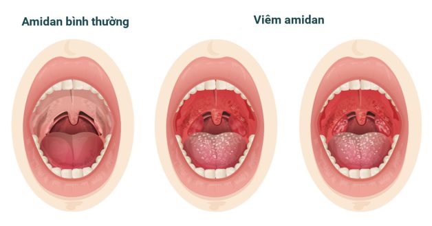 Chữa viêm Amidan cho trẻ: Tổng hợp phương pháp