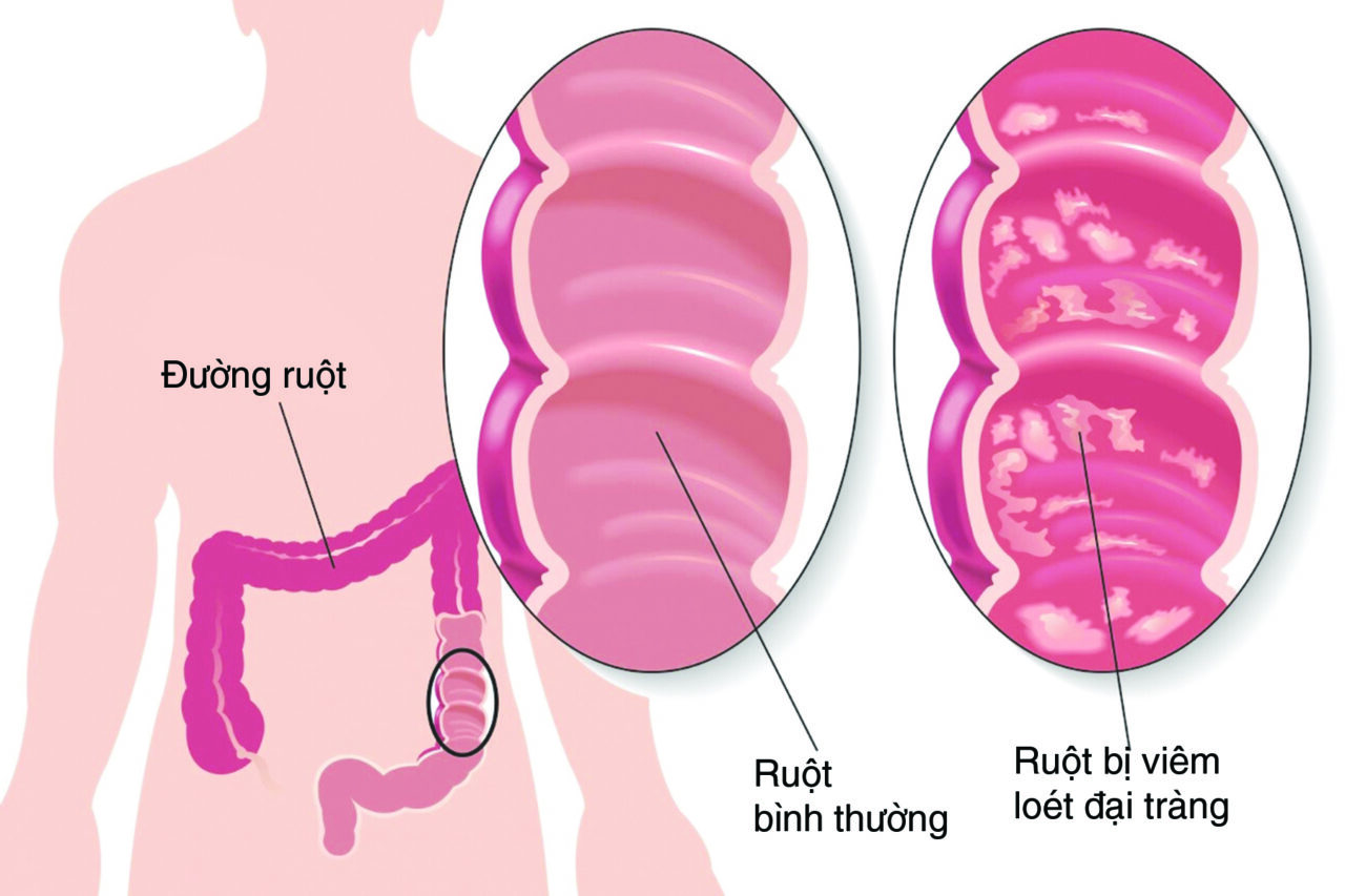 Chữa viêm đại tràng tại nhà như thế nào?