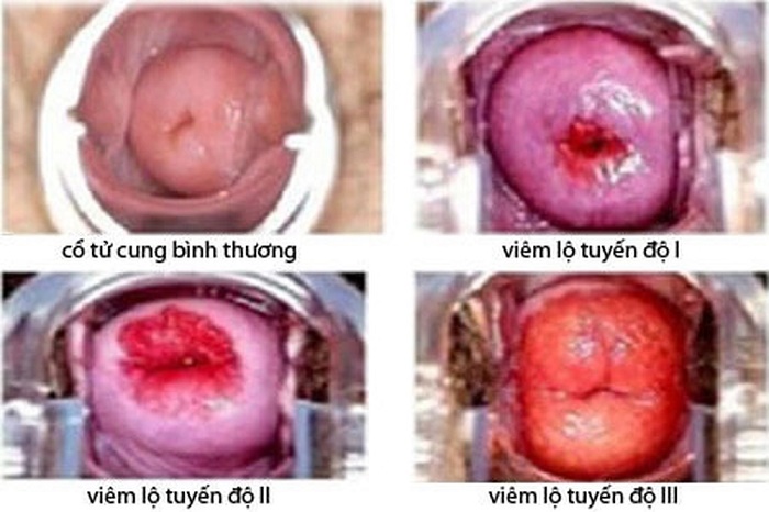 Chữa viêm lộ tuyến cổ tử cung bằng đốt điện