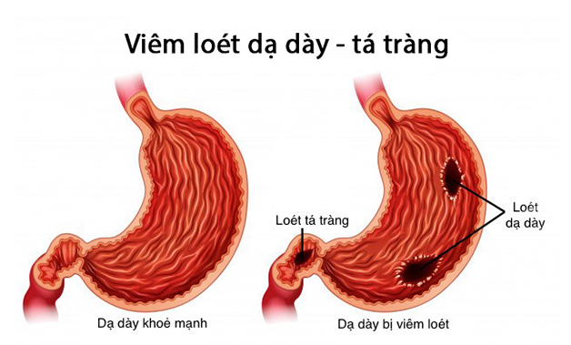 Chữa viêm loét dạ dày tá tràng theo phác đồ của bộ Y tế