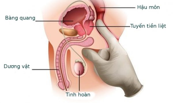 Chữa viêm tuyến tiền liệt thế nào?