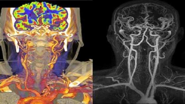 Chụp cắt lớp vi tính mạch máu chẩn đoán sớm đột quỵ