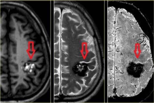 Chụp cộng hưởng từ MRI: Ưu nhược điểm, khi nào chụp?