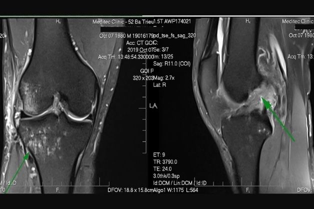 Chụp cộng hưởng từ MRI: Ưu nhược điểm, khi nào chụp?