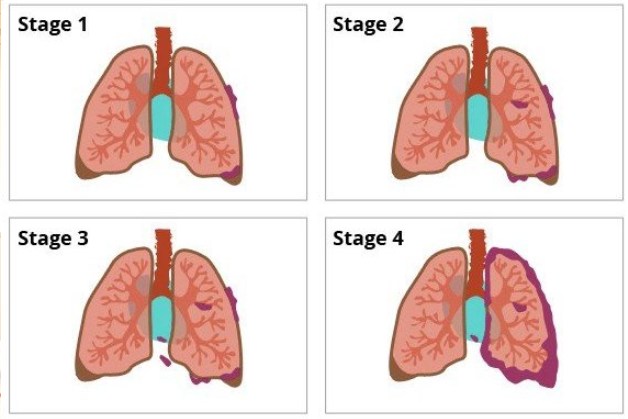 Chụp CT liều thấp tầm soát ung thư phổi như thế nào?