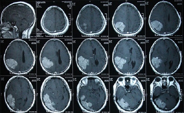 Chụp CT sọ não có ưu điểm gì? Có gây ảnh hưởng không?