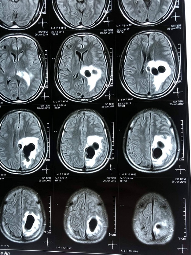 Chụp CT sọ não: Ưu, nhược điểm và cách tiến hành