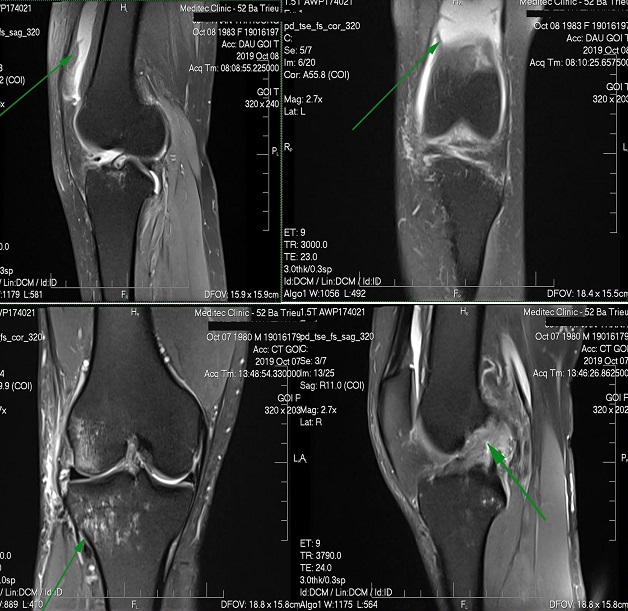 Chụp MRI dây chằng đầu gối được chỉ định khi nào?