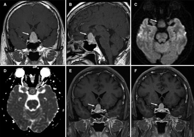 Chụp MRI giúp chẩn đoán hình ảnh u tuyến yên