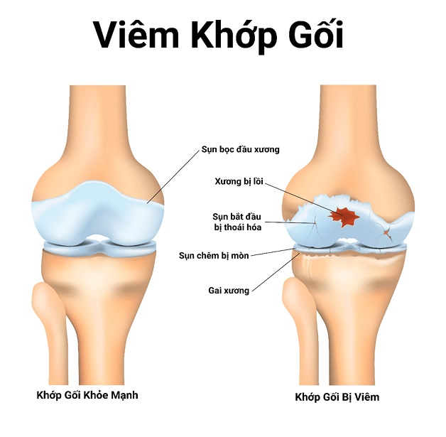 Chụp mri khớp gối ở đâu? Bao lâu thì có kết quả?