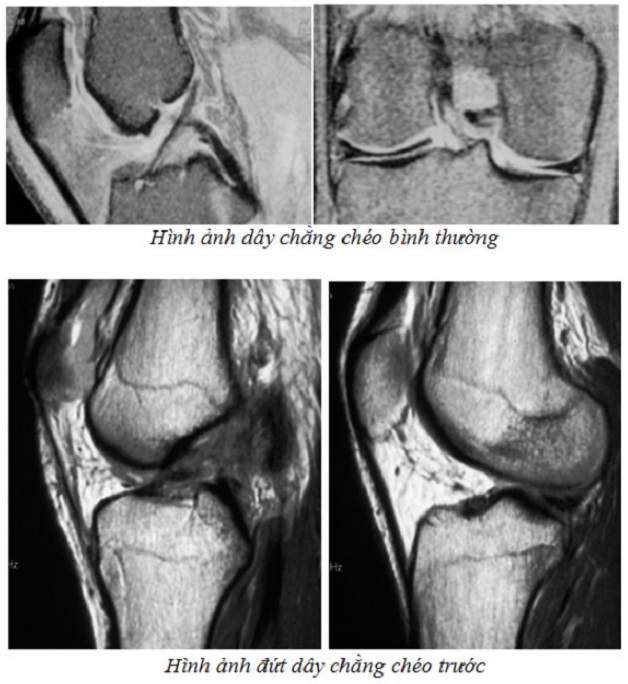 Chụp mri khớp gối ở đâu? Bao lâu thì có kết quả?