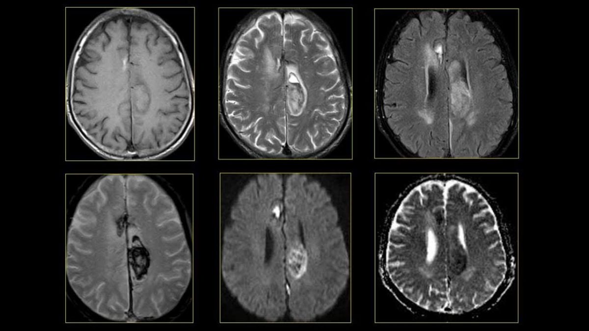 Chụp MRI mạch máu não có tác dụng gì, khi nào cần thiết?