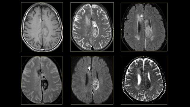 Chụp MRI não bộ giúp phát hiện những bệnh lý nào?