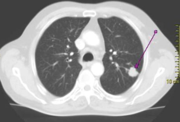 Chụp MRI ngực có thể phát hiện những bệnh lý nào?