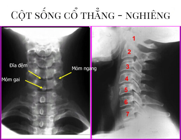 Chụp X quang cột sống cổ: nên hay không? 